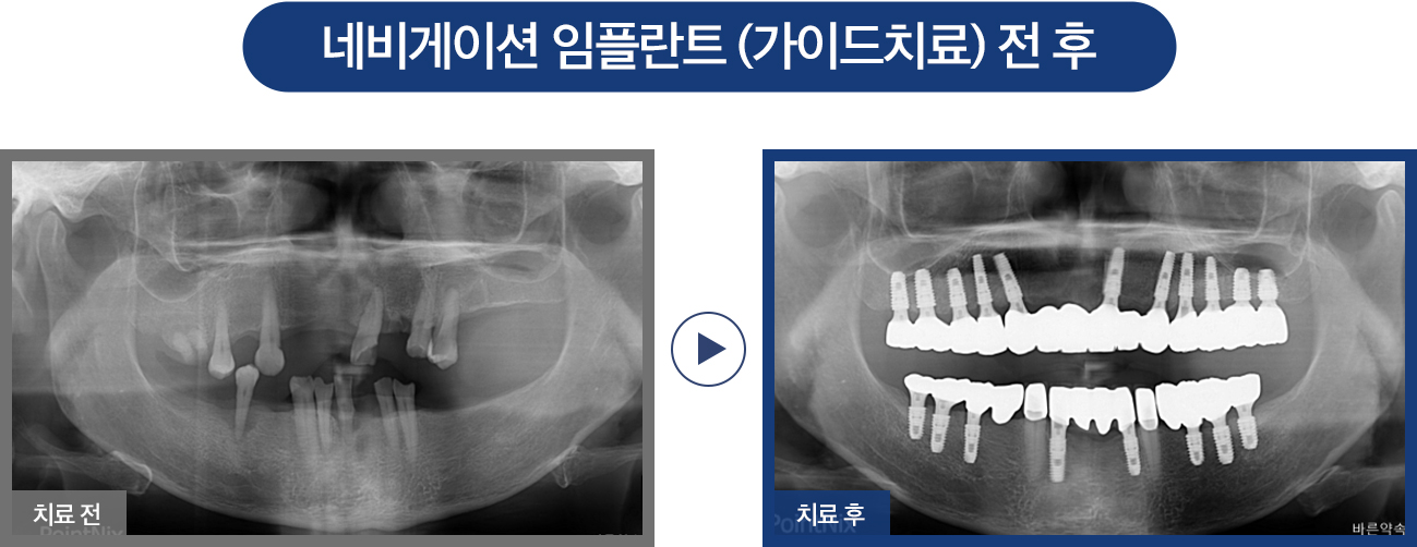임플란트 증례01