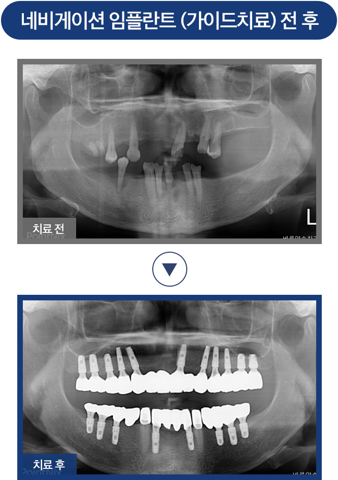 임플란트 증례01