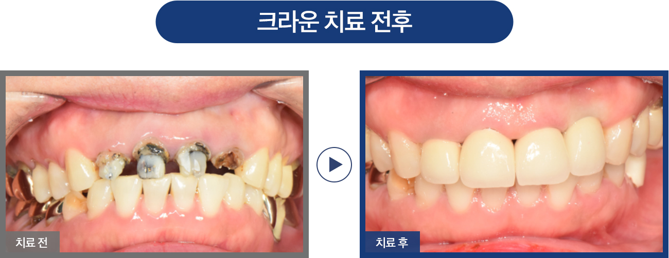 자연치아 살리기 증례01