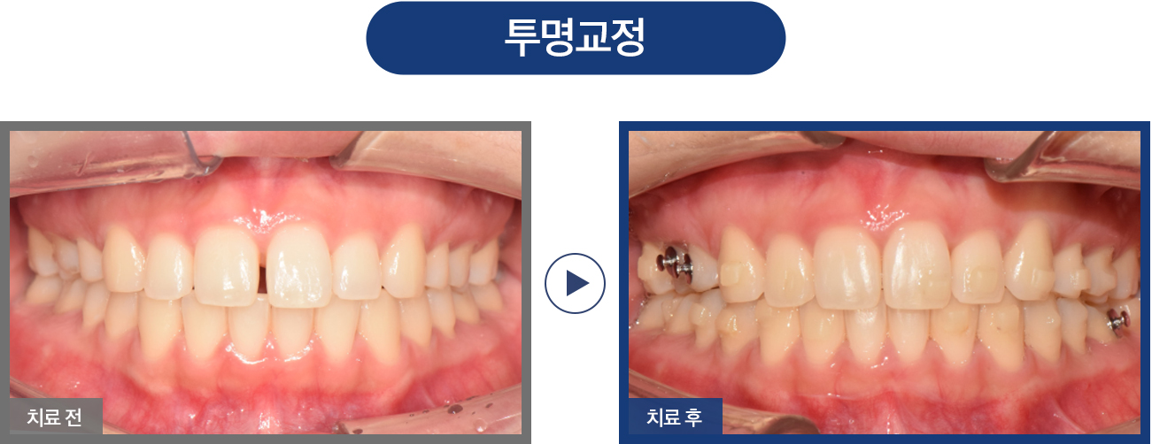 투명 교정 증례01