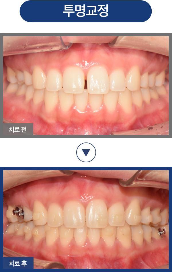 투명 교정 증례01
