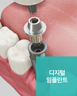 디지털 임플란트