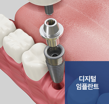 디지털 임플란트