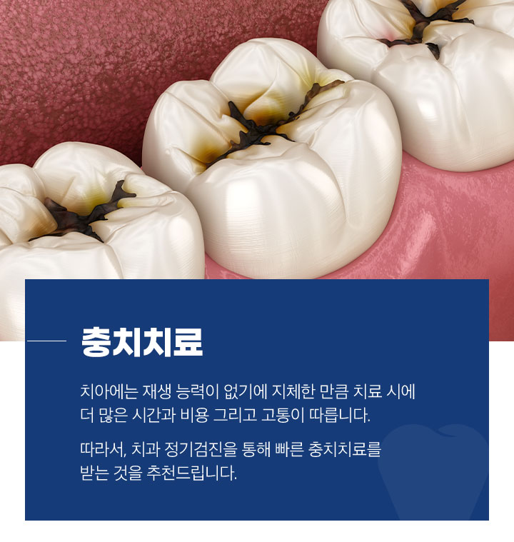충치치료