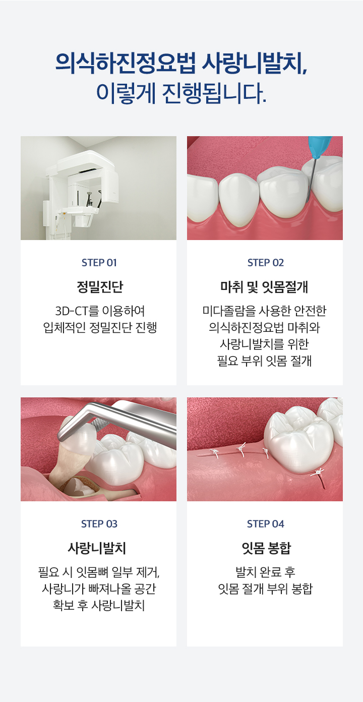 의식하진정요법 사랑니발치, 이렇게 진행됩니다.