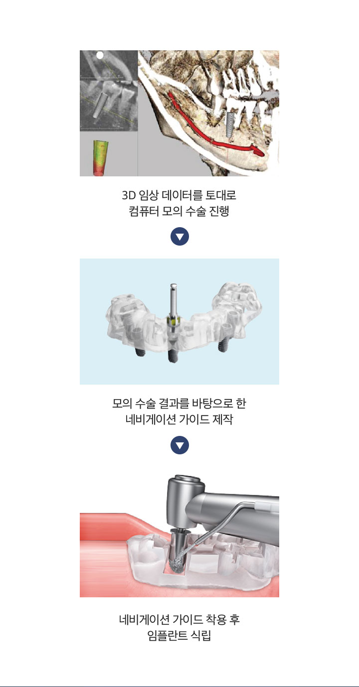 네비게이션 임플란트 진행순서
