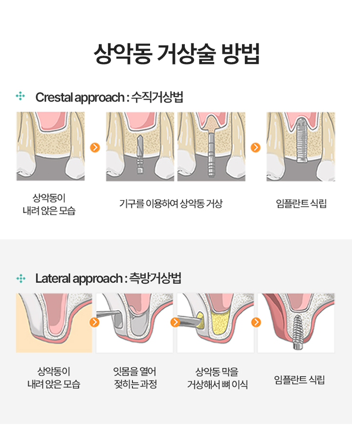 상악동 거상술 방법