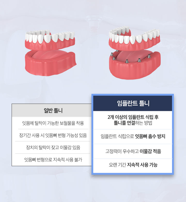 보험 임플란트도 정품 인증 받은 제품으로!