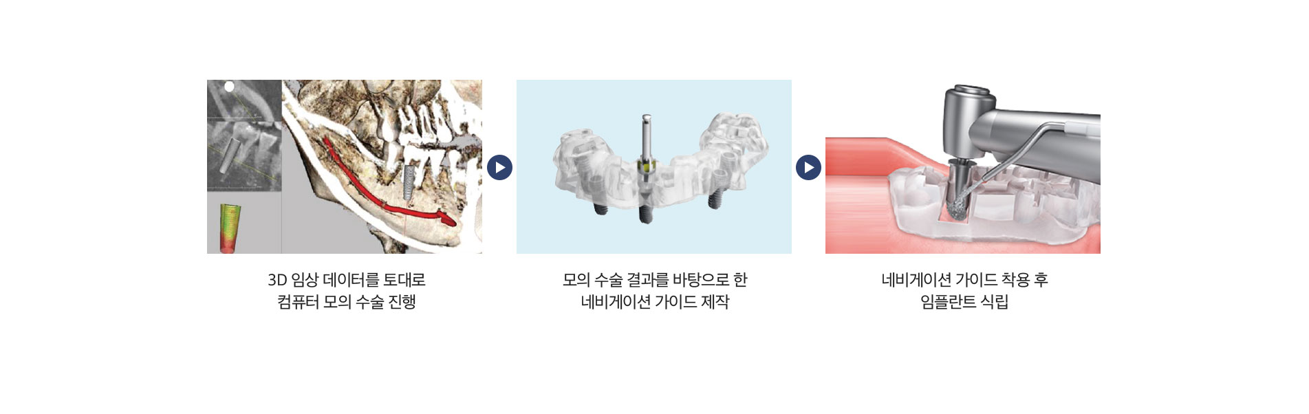 네비게이션 임플란트 진행순서