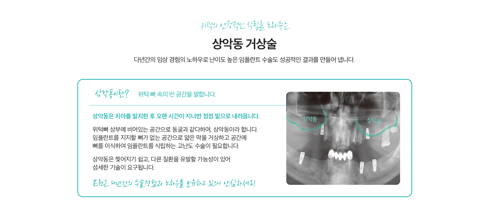 위턱의 안정적인 식립을 도와주는 상악동 거상술