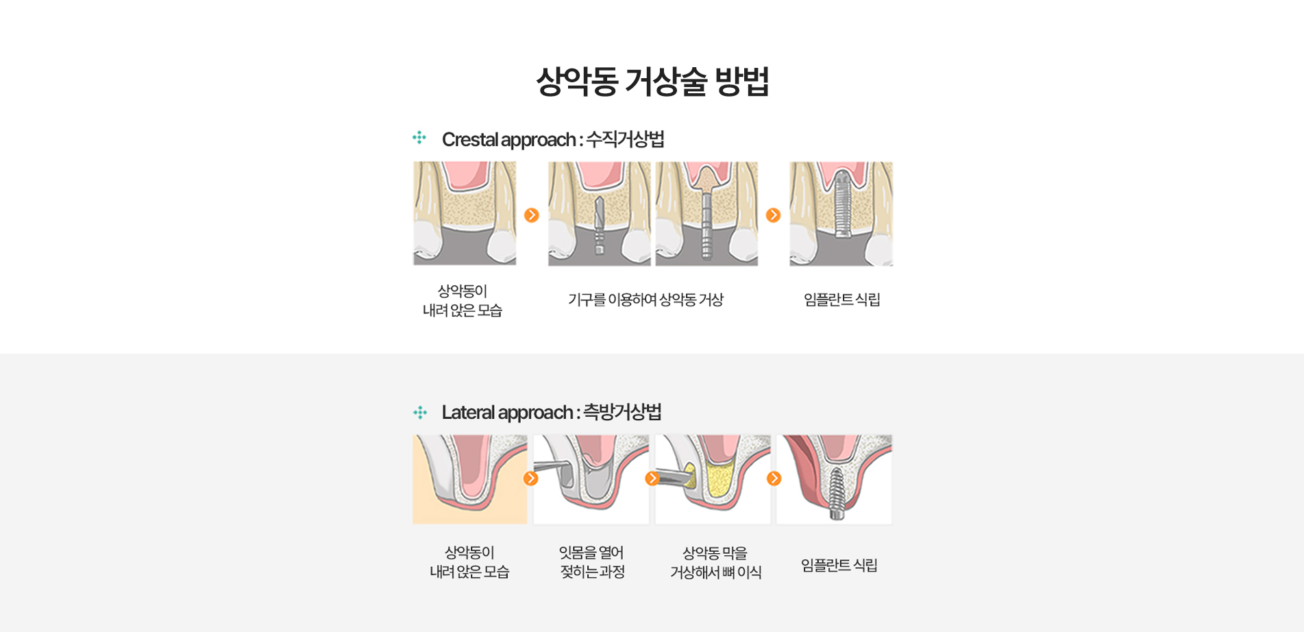 상악동 거상술 방법