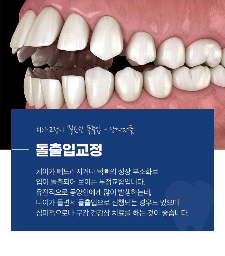 돌출입교정