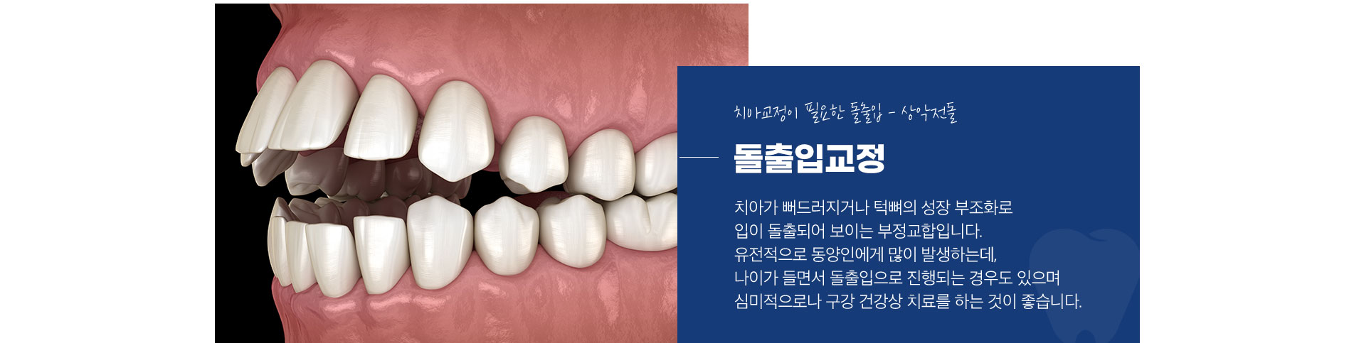 돌출입교정