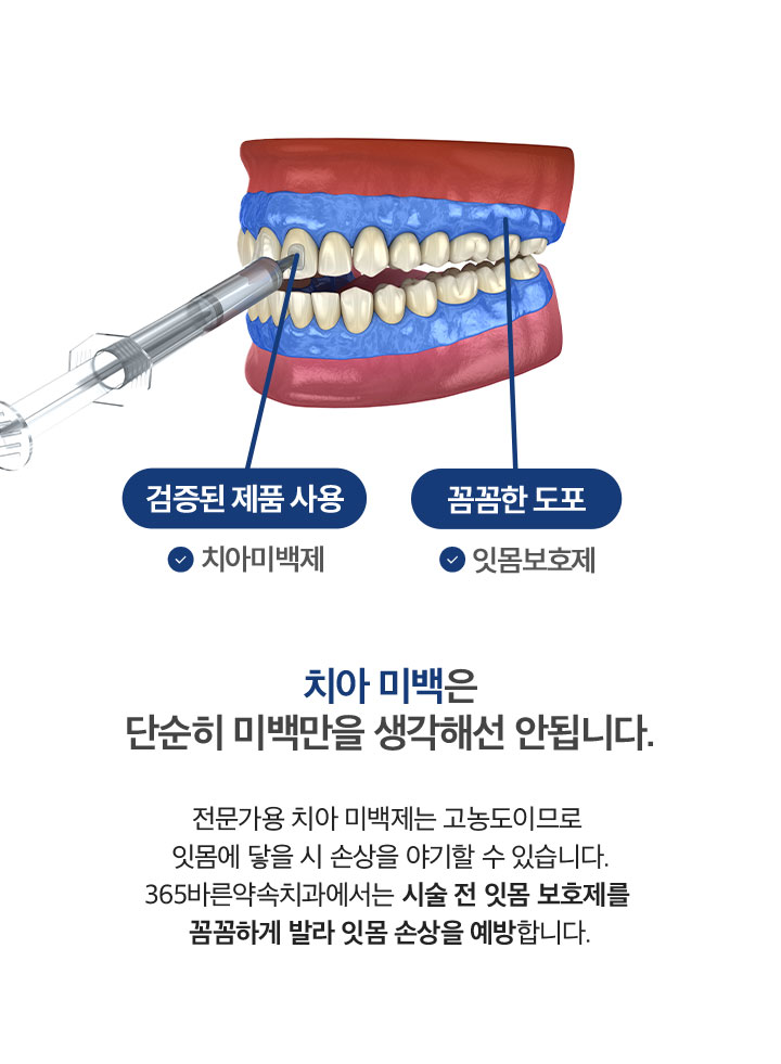 치아 미백은 단순히미백만을 생각해선 안됩니다.
