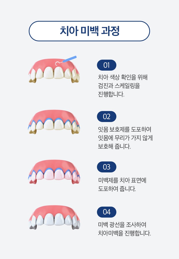 치아 미백 과정