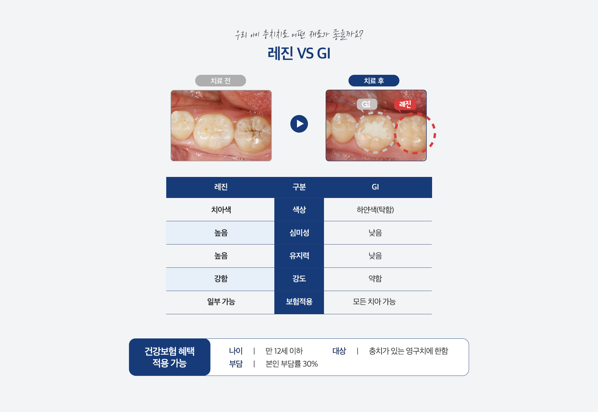 우리 아이 충치치료 어떤 재료가 좋을까요? 레진 vs GI